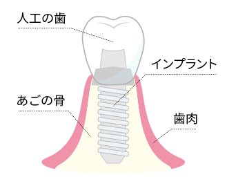 インプラントとは？